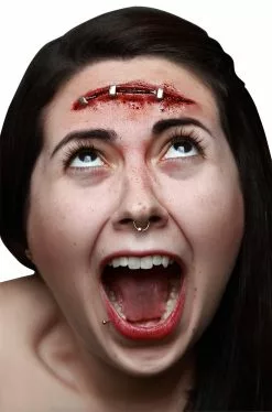 Metal Staples Prosthetic Kit